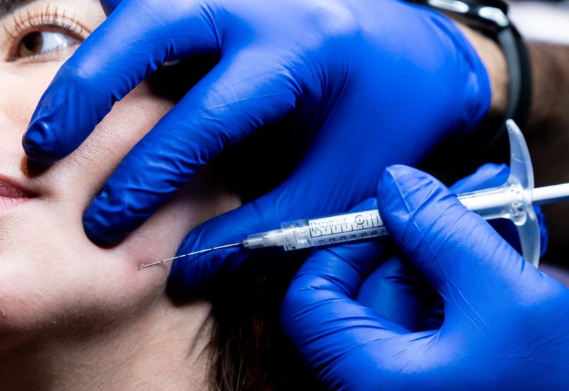 Dermal Filler Tampa