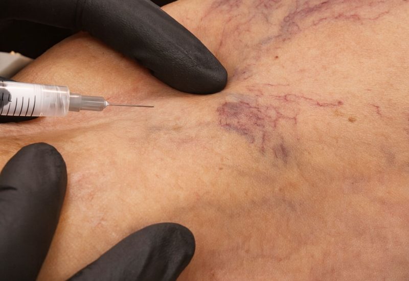 Sclerotherapy Tampa