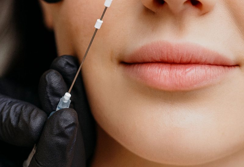 PDO Thread Lift Tampa