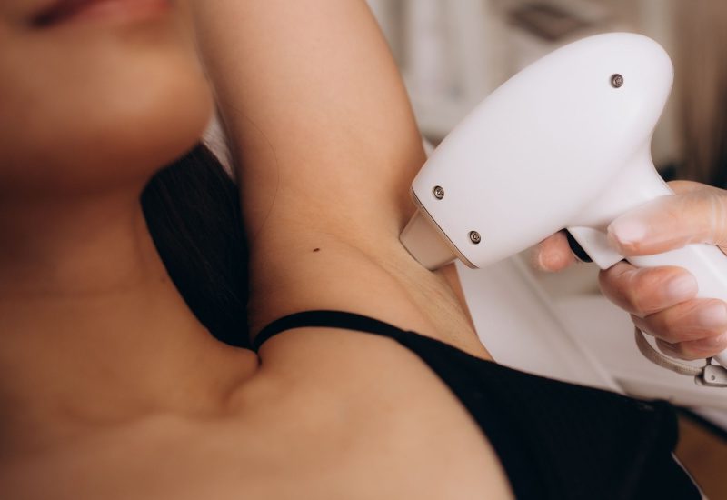 LASER HAIR REMOVAL TAMPA