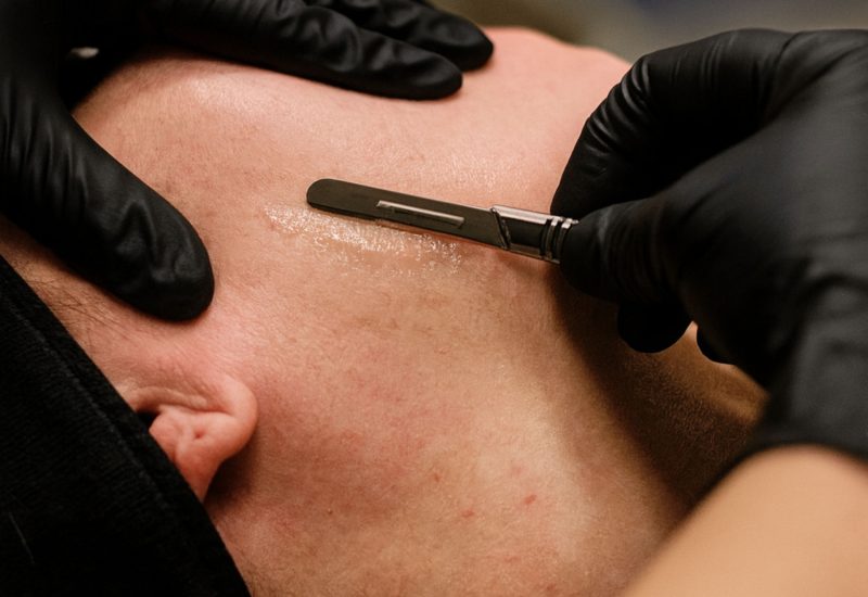 Dermaplaning in Tampa